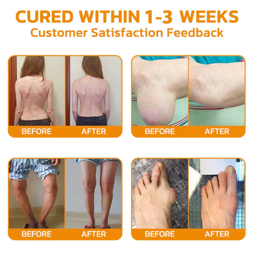 Bee Venom Arthritis Treatment Cream