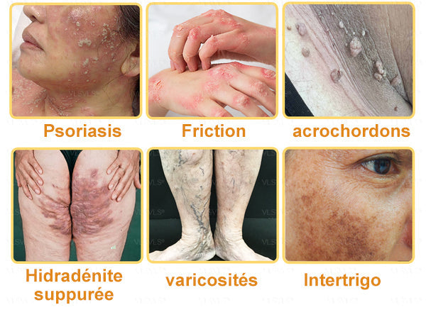 Venin d'abeille Creme de tratamento da artrite em venin d'abeille