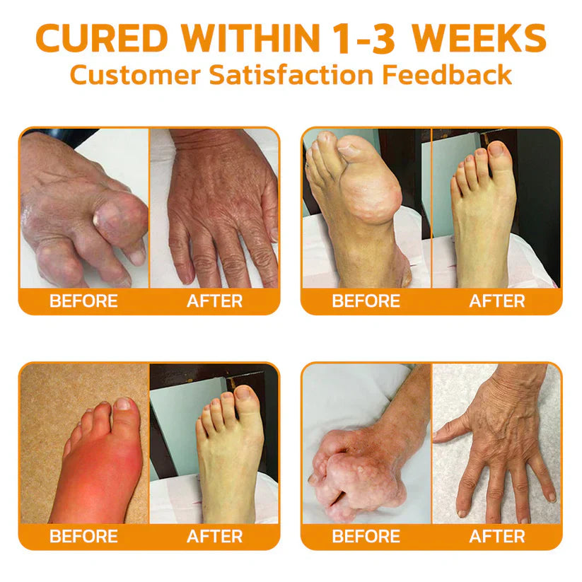 Bee Venom Arthritis Treatment Cream