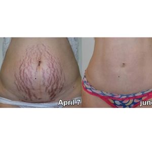 Bee Venom Shaping cream : Sculptez votre corps de rêve avec notre crème – Résultats visibles rapidement !