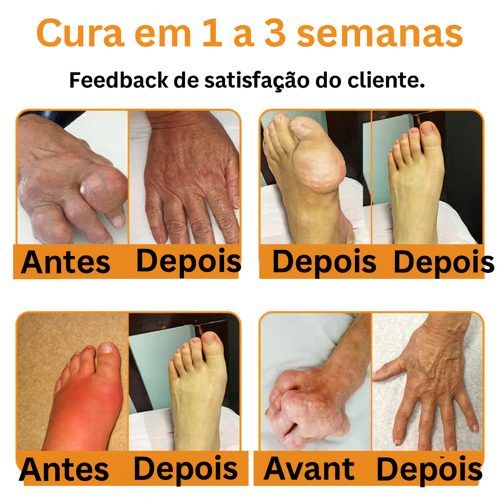 Veneno de abelha – Creme para tratamento da artrite com veneno de abelha